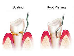 Teeth Cleaning Scaling & Root Planing
