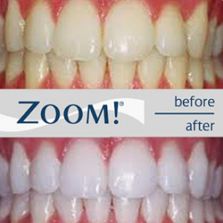 Zoom! Teeth Whitening